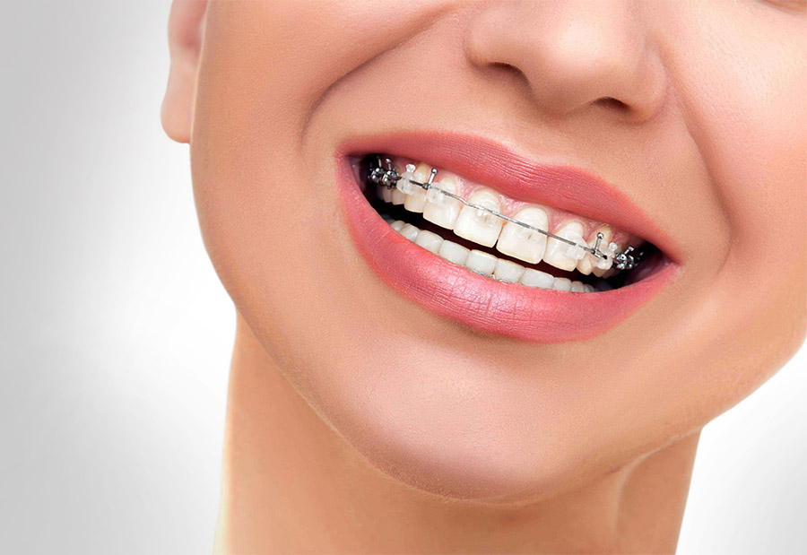 Teeth Braces in Mirdif