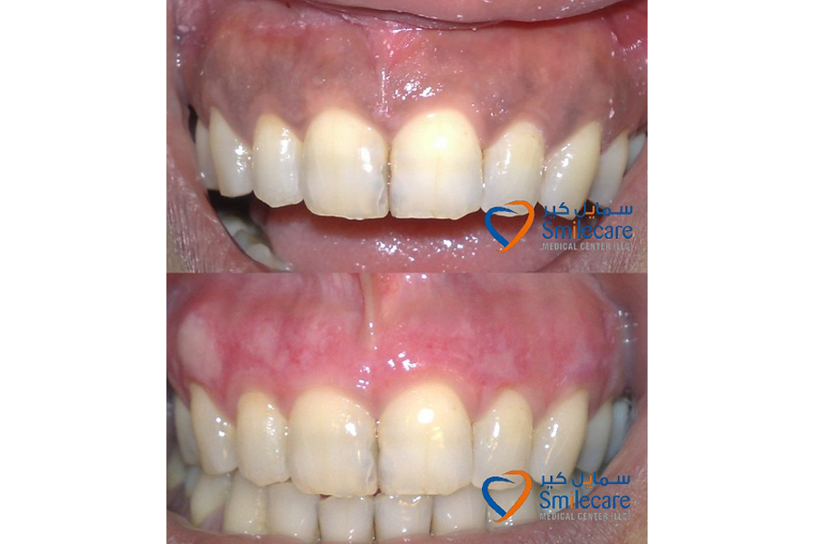 dental veneers dubai