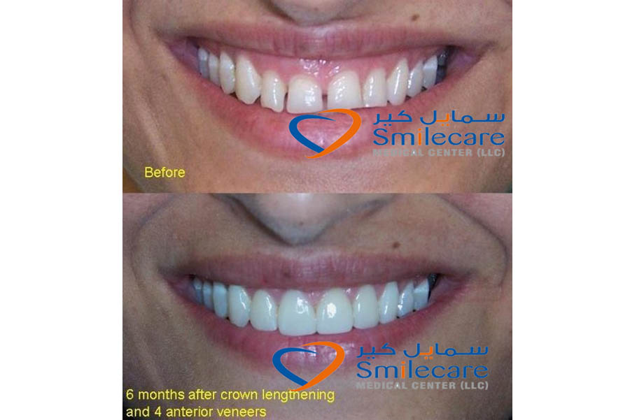 Dental veneers Dubai