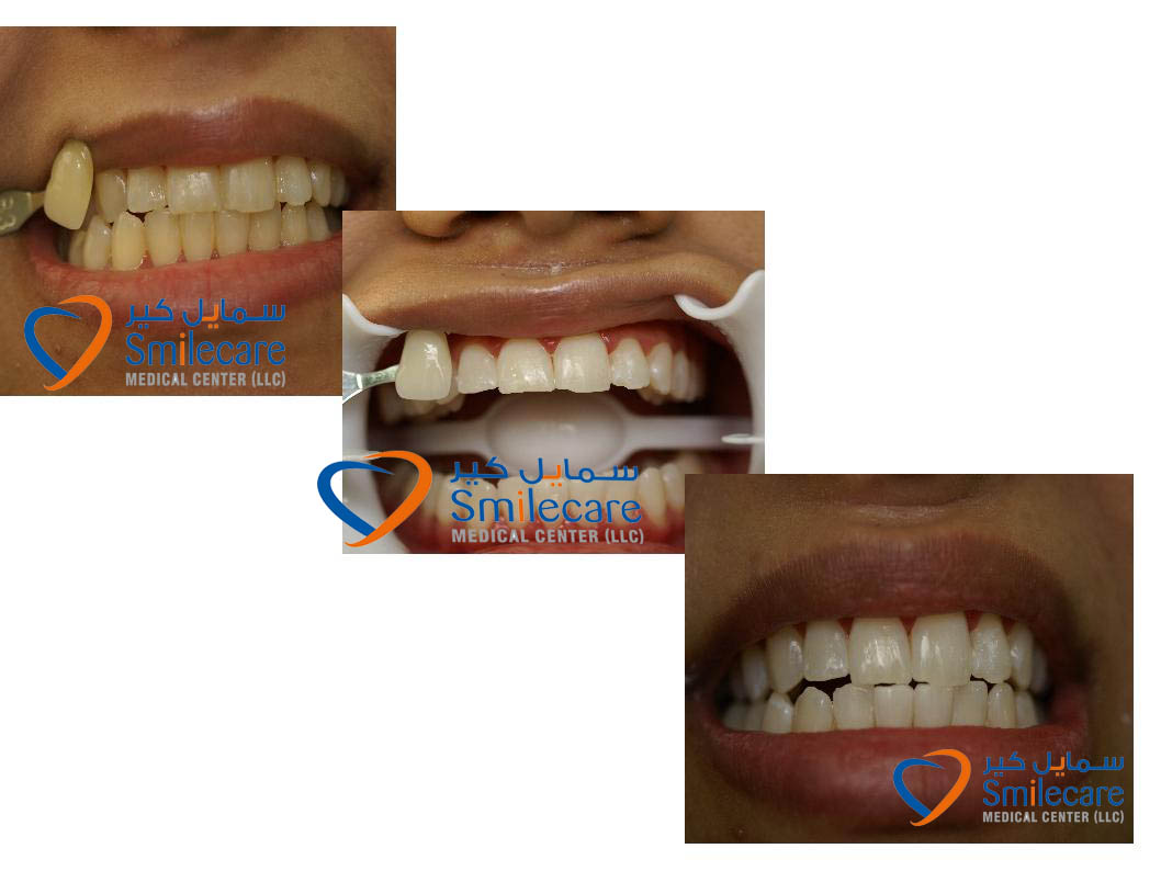 Teeth scaling and polishing dubai