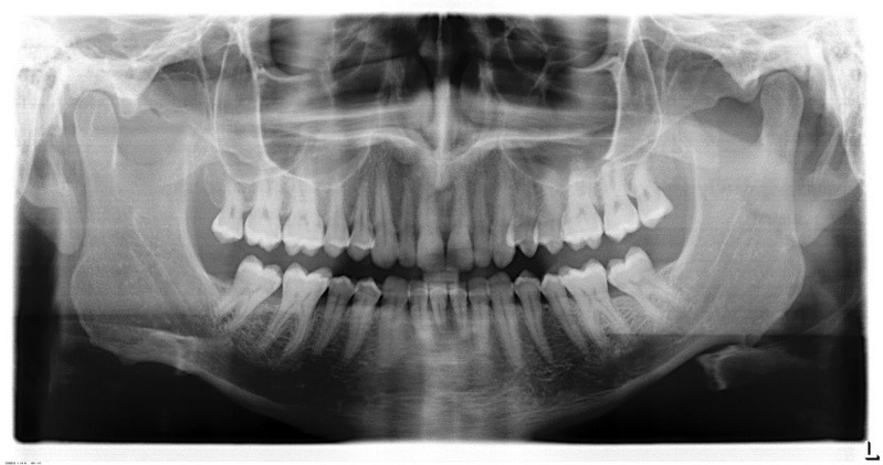 Panoramic X-rays