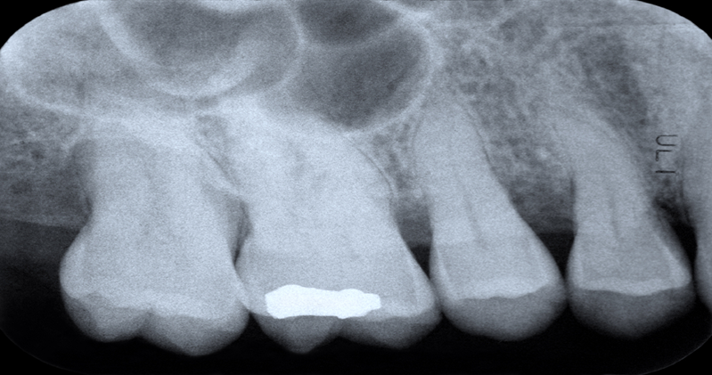 Periapical X-rays