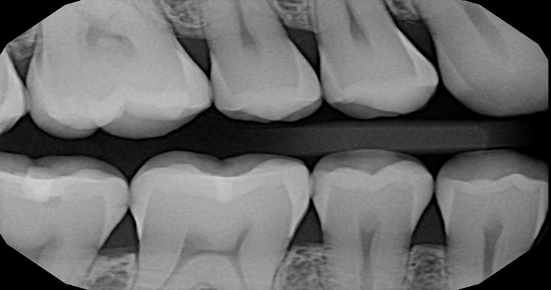 Bite-wing X-rays 