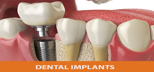 dental-implants-blog-10-december2.png